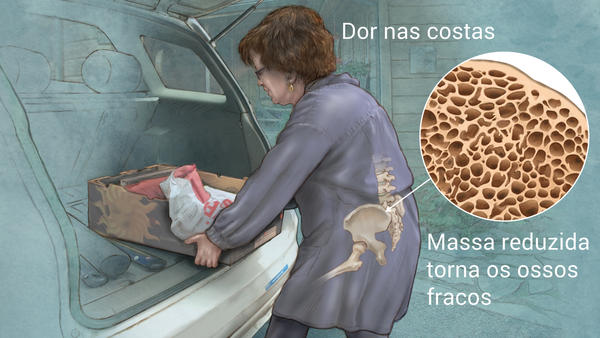 osteoporose-tratamento